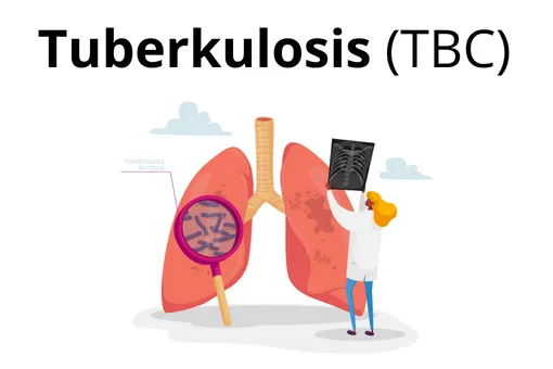 Alarm Kesehatan, Sebaran Tuberkolosis di Indonesia Tembus 1 Juta Kasus